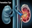 Kidney Stone Prevention Tips