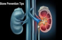 Kidney Stone Prevention Tips