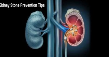 Kidney Stone Prevention Tips
