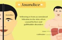 Understanding Bilirubin and the Cause of the Yellow Color