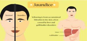 Understanding Bilirubin and the Cause of the Yellow Color