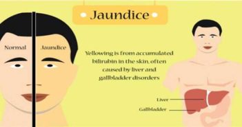 Understanding Bilirubin and the Cause of the Yellow Color Understanding Bilirubin and the Cause of the Yellow Color