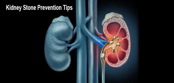 Kidney Stone Prevention Tips